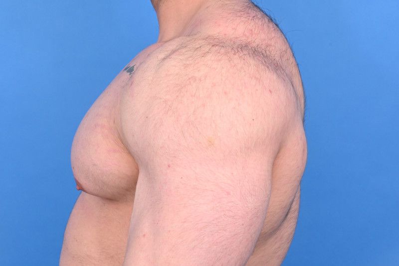 Gynecomastia Surgery Before & After Image