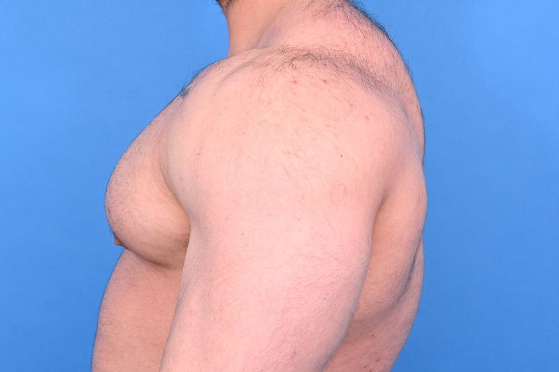 Gynecomastia Surgery Before & After Image