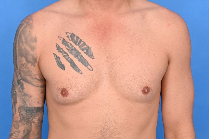 Gynecomastia Surgery Before & After Image