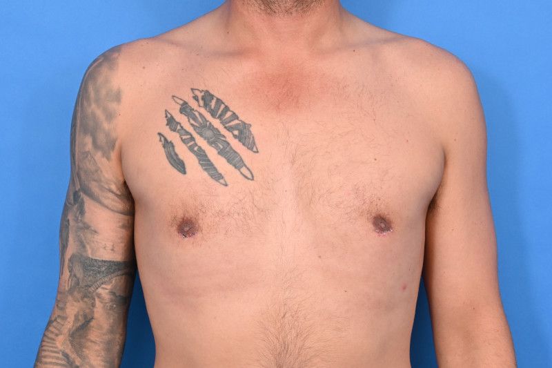 Gynecomastia Surgery Before & After Image