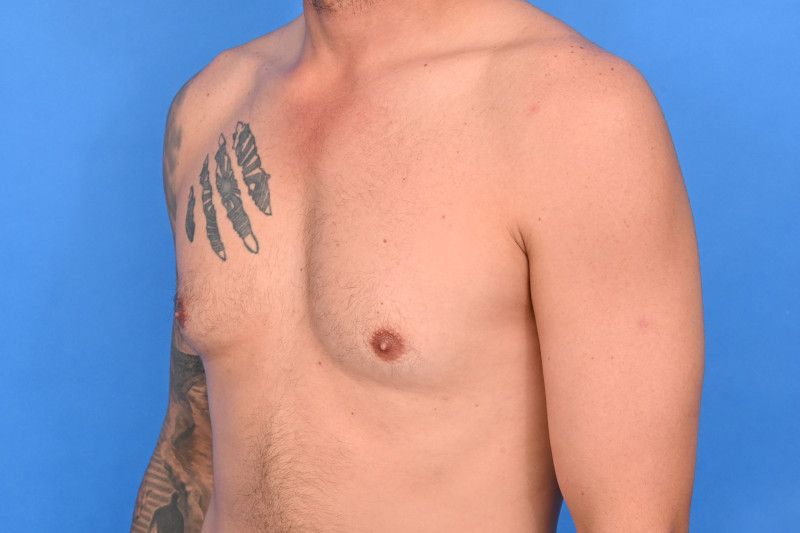 Gynecomastia Surgery Before & After Image