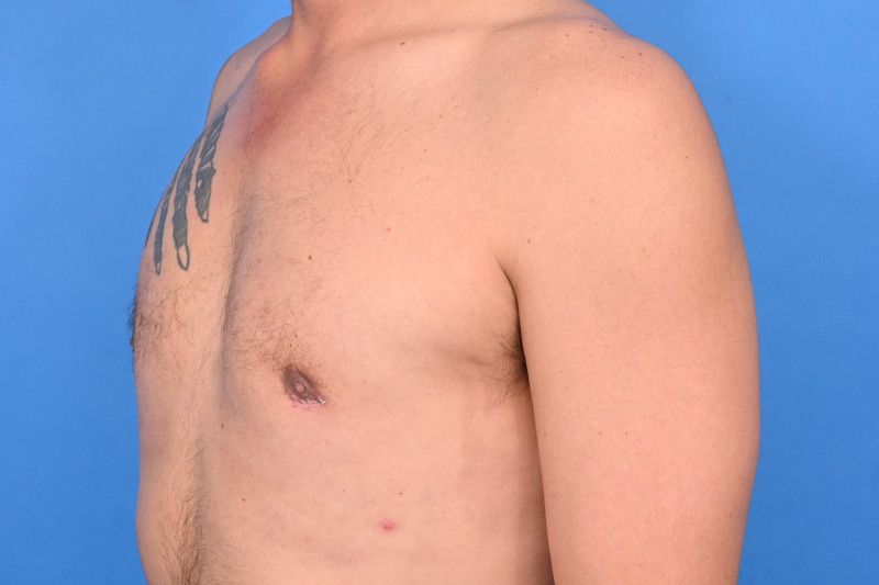 Gynecomastia Surgery Before & After Image