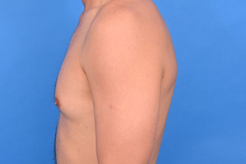 Gynecomastia Surgery Before & After Image
