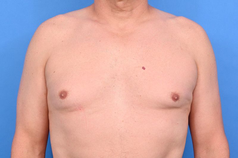 Gynecomastia Surgery Before & After Image