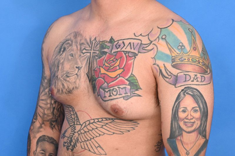 Gynecomastia Surgery Before & After Image