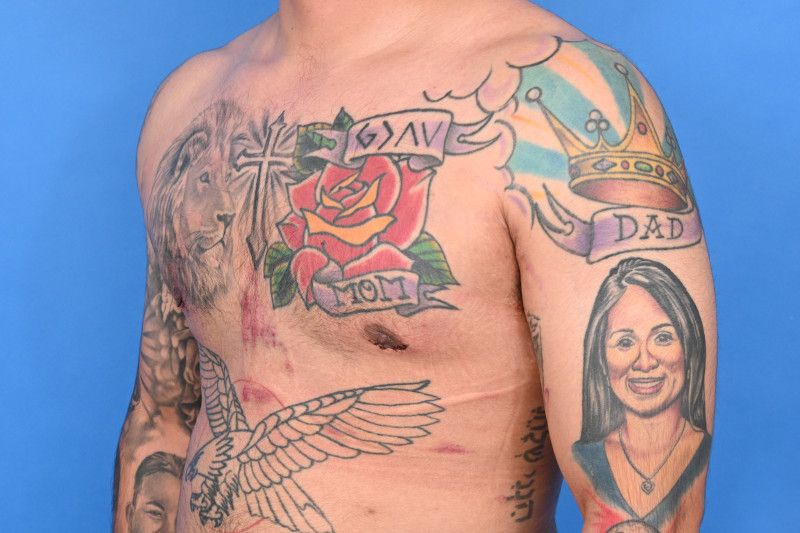 Gynecomastia Surgery Before & After Image