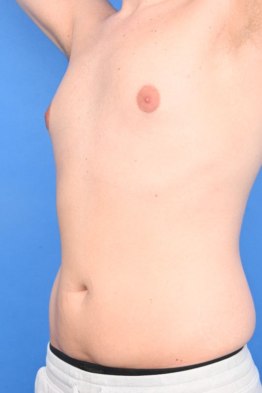 Gynecomastia Surgery Before & After Image