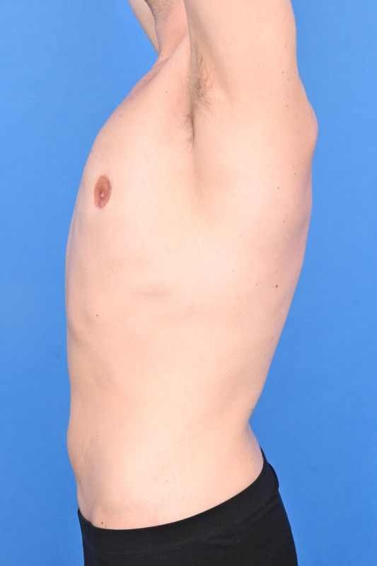 Gynecomastia Surgery Before & After Image