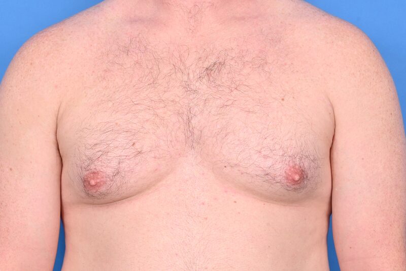Gynecomastia Surgery Before & After Image