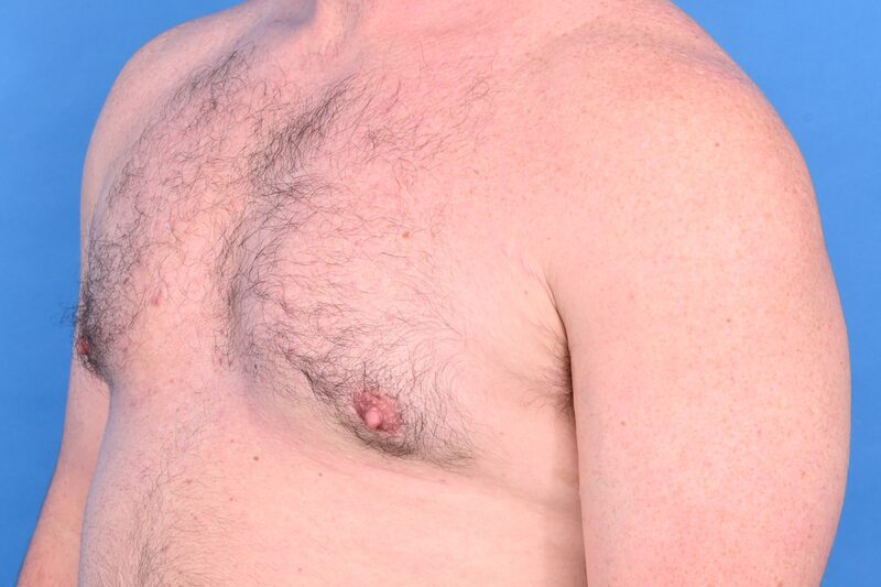 Gynecomastia Surgery Before & After Image