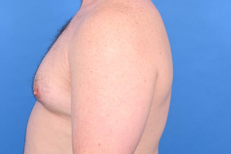 Gynecomastia Surgery Before & After Image