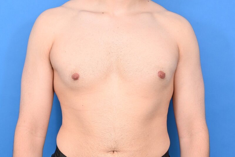Gynecomastia Surgery Before & After Image