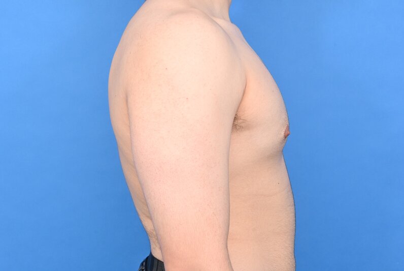 Gynecomastia Surgery Before & After Image