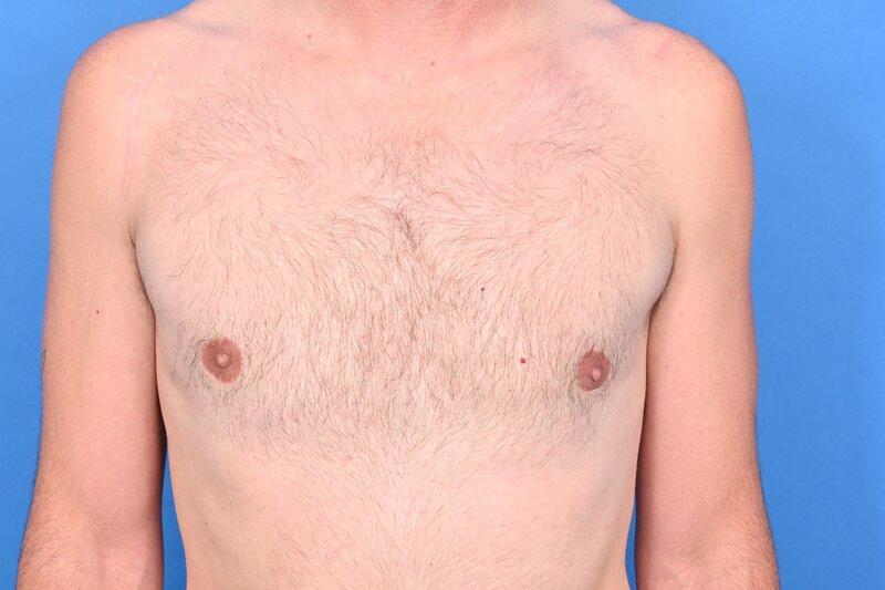 Gynecomastia Surgery Before & After Image