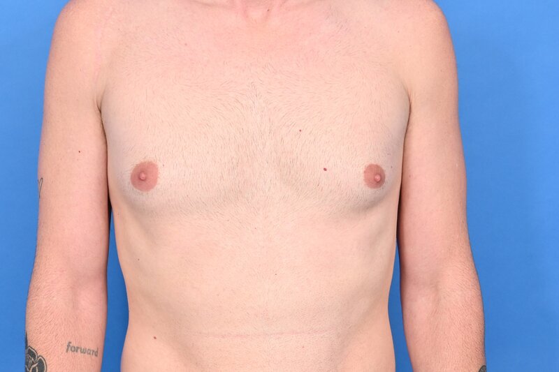 Gynecomastia Surgery Before & After Image