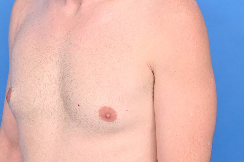 Gynecomastia Surgery Before & After Image