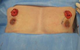Revision Gynecomastia Surgery Before & After Image