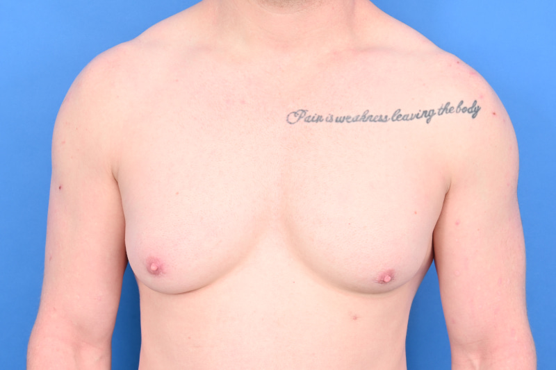 Revision Gynecomastia Surgery Before & After Image