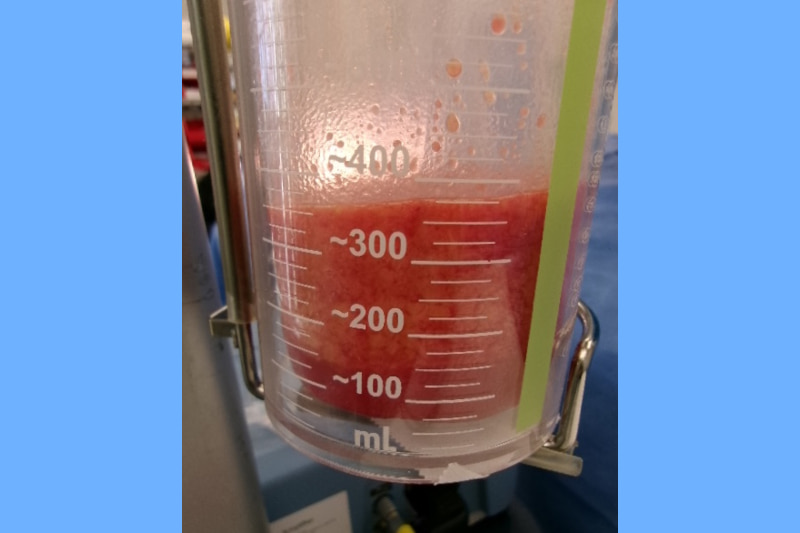 Revision Gynecomastia Surgery Before & After Image