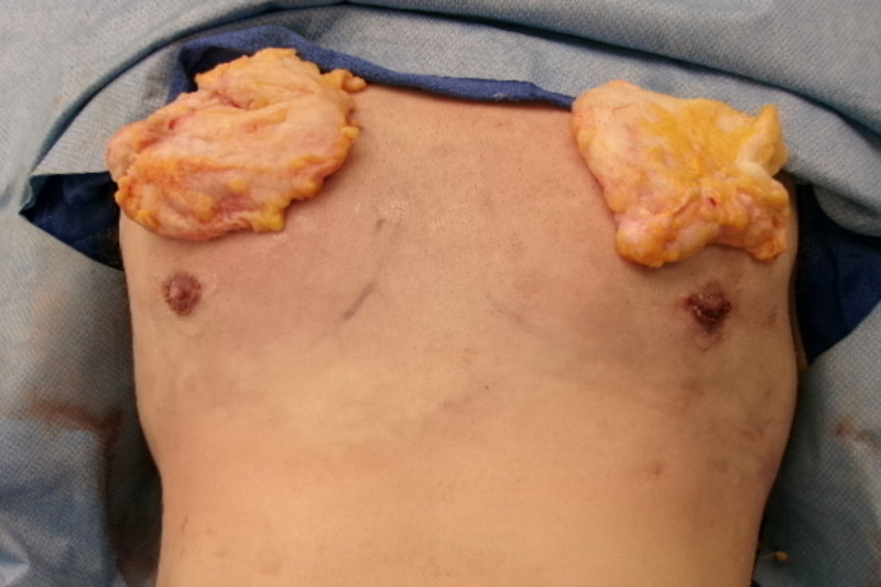 Revision Gynecomastia Surgery Before & After Image